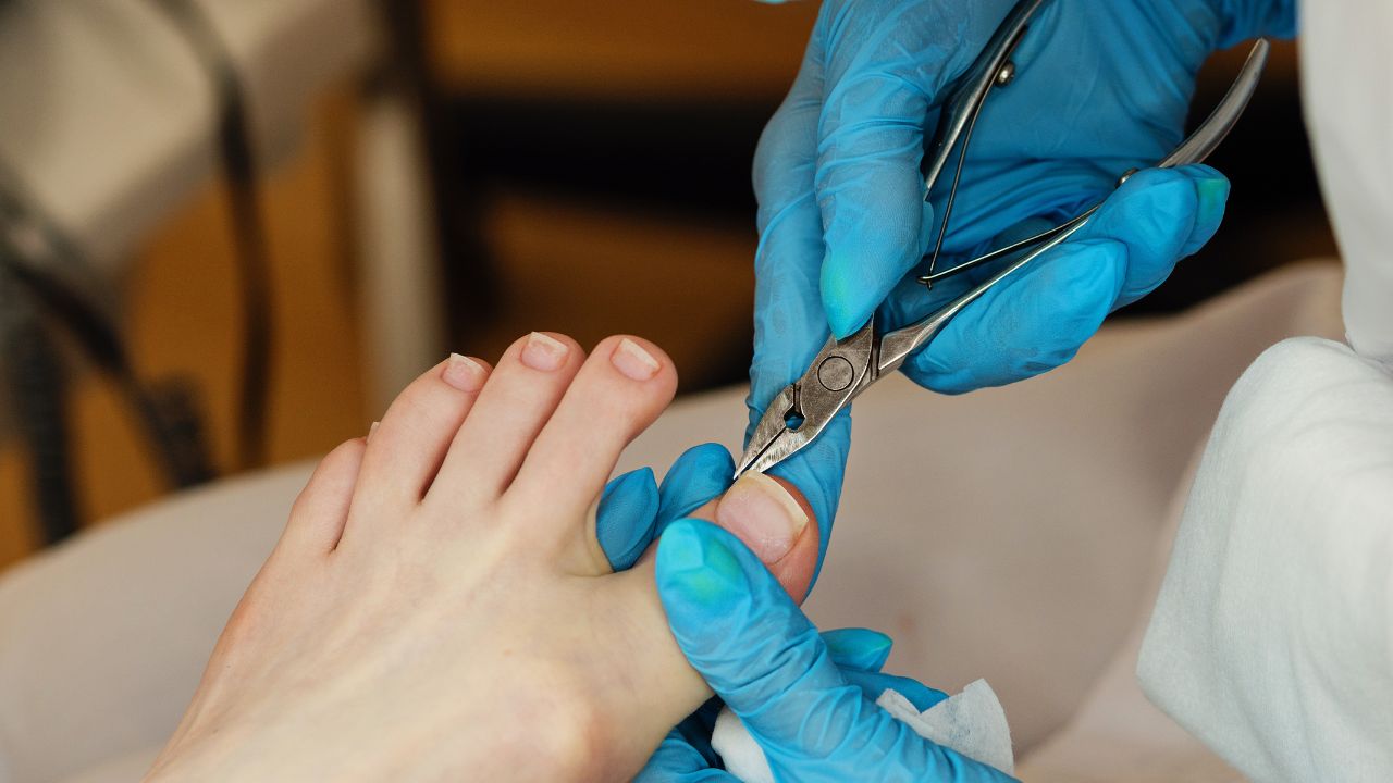 BURNING A HOLE THROUGH A TOENAIL (with blood trapped under it) | Dr. Paul -  YouTube